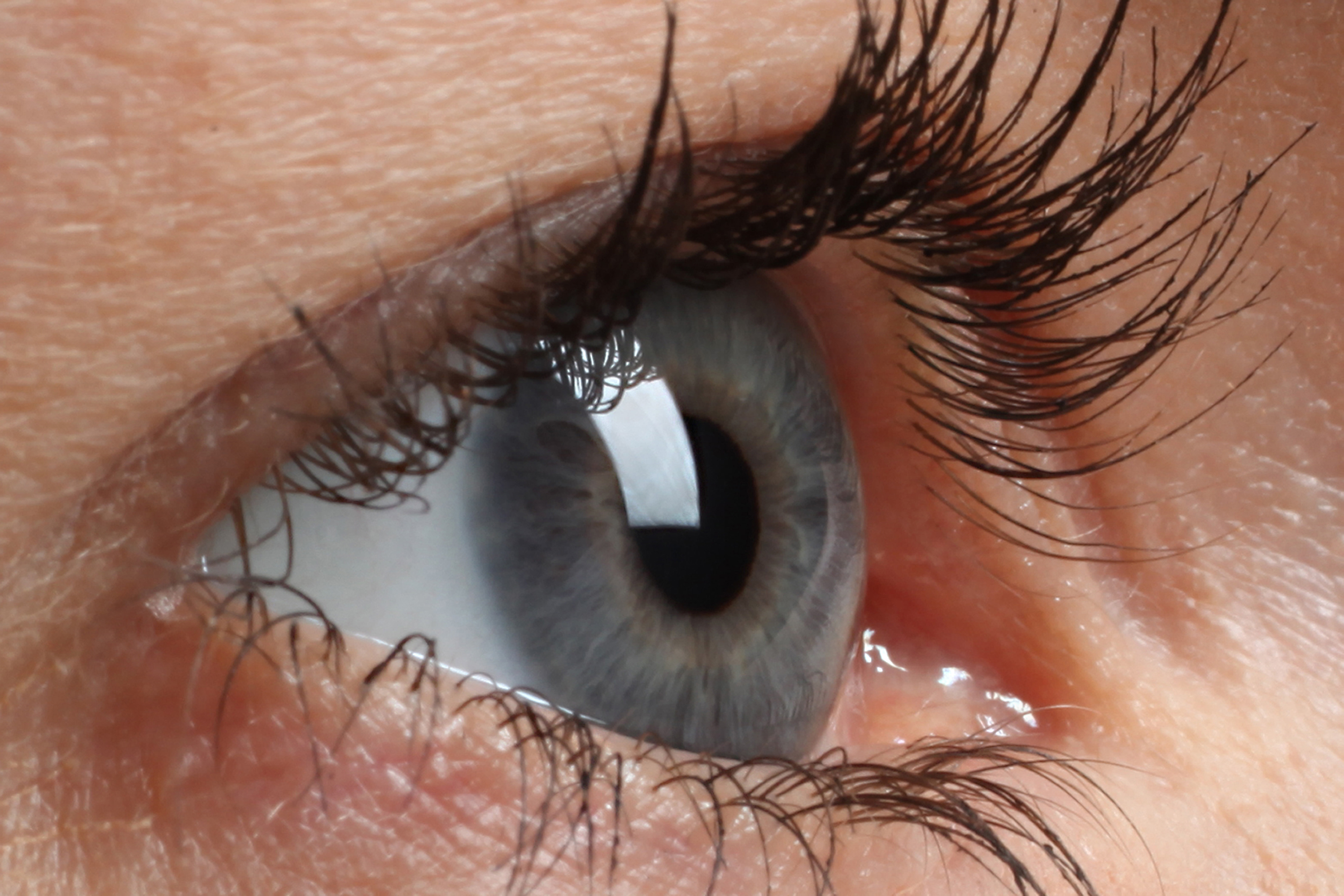 Myopic macular degeneration primary image