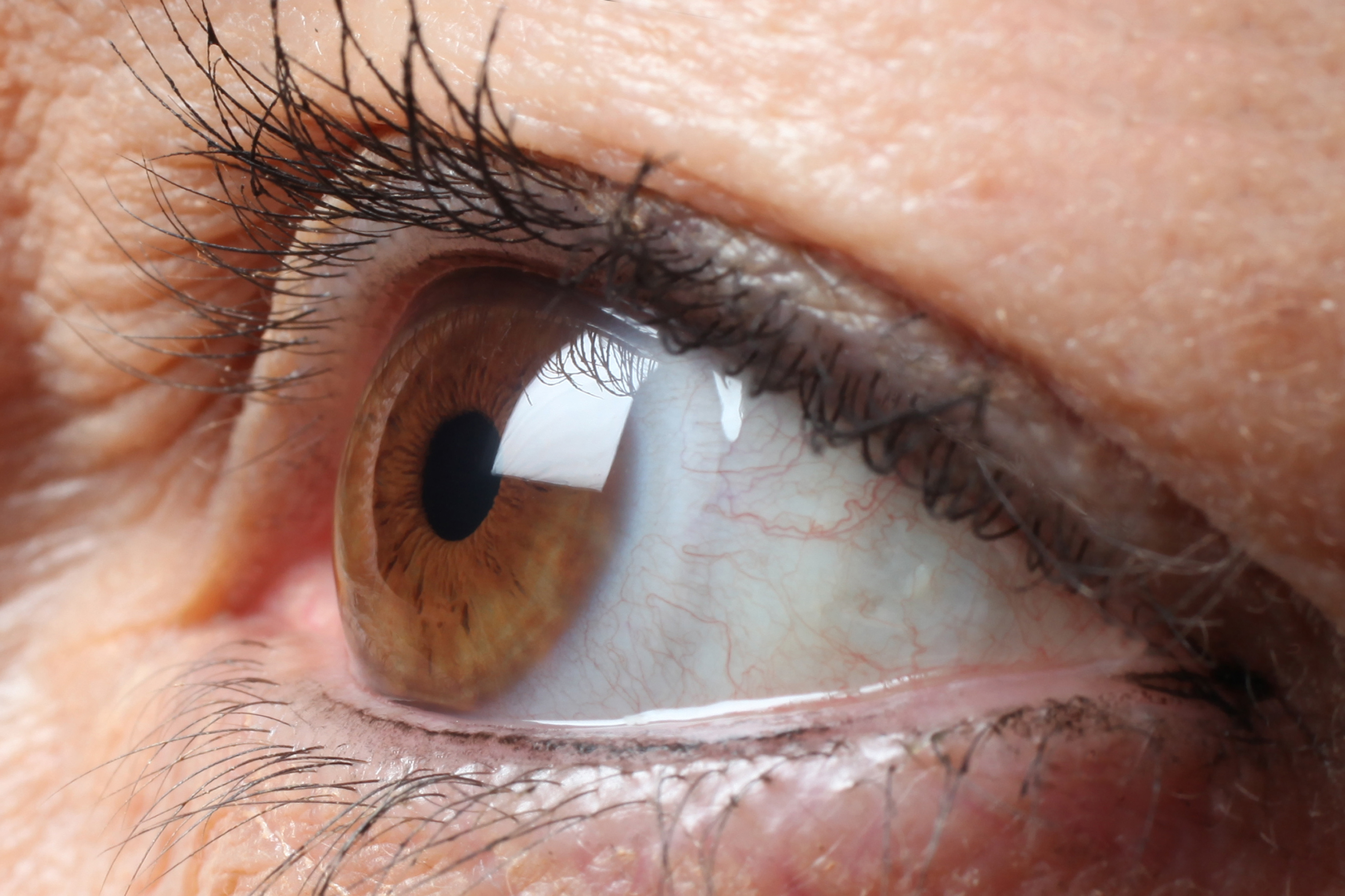 Wet age-related macular degeneration primary image