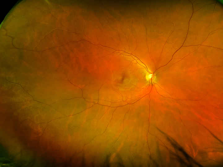 retina_macular_eye_blood_vessels.jpeg