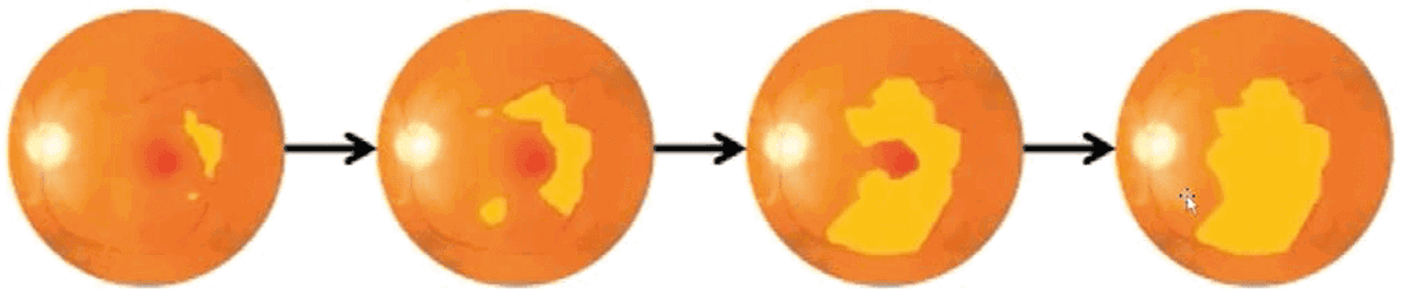 Diagram Of Atrophy Spreading