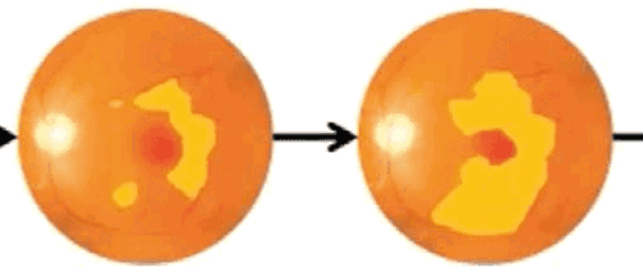 Diagram Of Atrophy Spreading