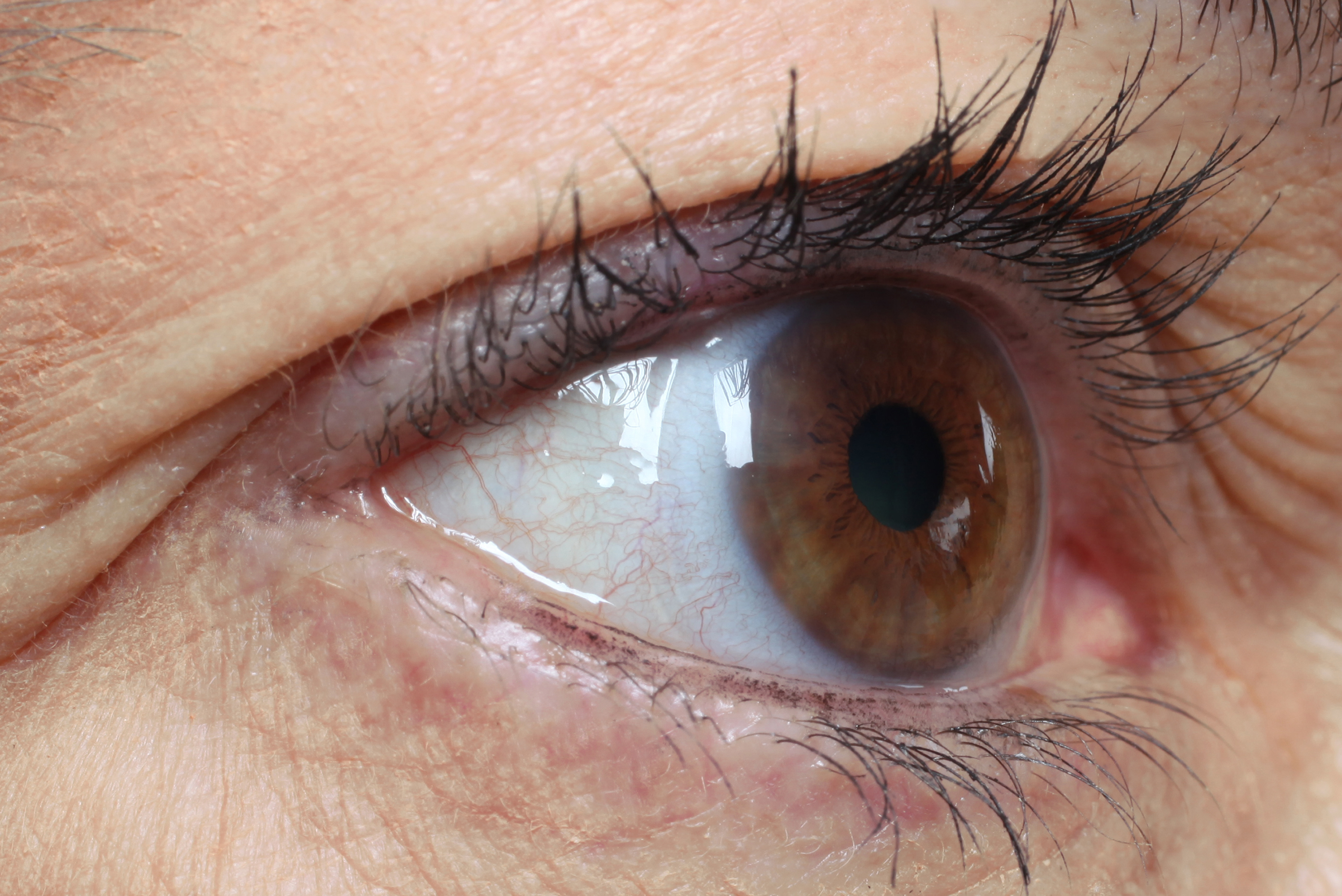 Bull’s eye maculopathy primary image
